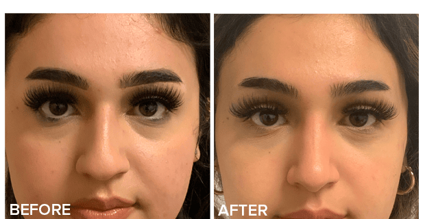 Rhinoplasty Nose Reshaping Before And After