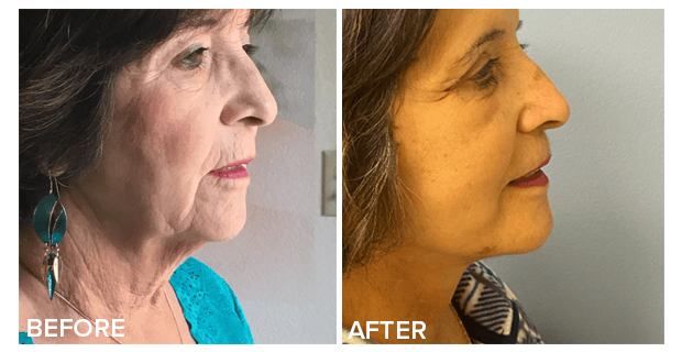 Facelift And Upper And Lower Lid Blepharoplasty Before And After