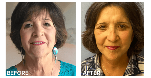 Facelift And Upper And Lower Lid Blepharoplasty Before And After