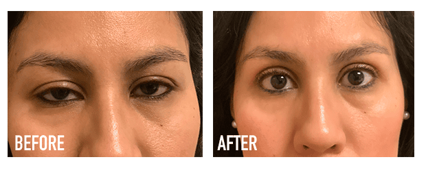 Upper Lid Lift Blepharoplasty Before And After