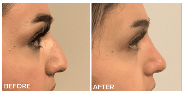 Rhinoplasty Nose Reshaping Before And After