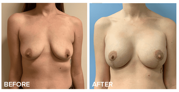 Breast Augmentation With Lift Before And After